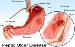 Tự bảo vệ dạ dày trước khi bị thủng