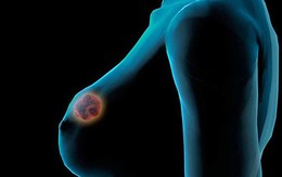 Ung thư vú đe dọa mạng sống phụ nữ trẻ