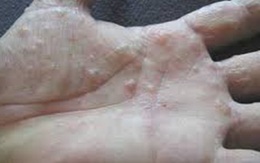 Bị á sừng kèm tổ đỉa phải làm sao?