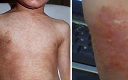 Bị viêm da nên chữa ở đâu?