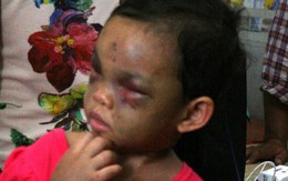 Bé gái 4 tuổi bị đánh dã man: Ruột thịt lại ấm nồng, kẻ nhẫn tâm chờ chịu tội