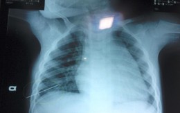 Bé trai 3 tuổi bị kim may đâm thấu ngực gây thủng phổi