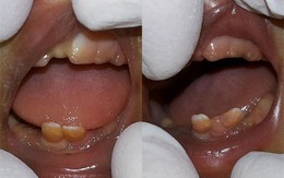 Hai em bé vừa chào đời đã... đầy một miệng răng