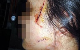 Lật tẩy chiêu trò tung tin nữ sinh bị cướp rạch mặt ở Hà Nội