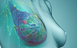 Phát hiện mới về nguyên nhân gây ung thư vú