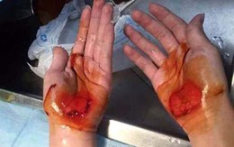Giáo viên bắt học sinh bò bằng tay đến chảy máu