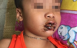 Cháu bé 5 tuổi nhập viện vì ăn nhầm bột thông cống