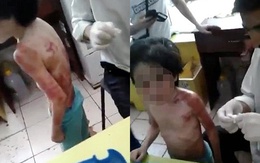 Chấn động bé 6 tuổi bị mẹ đánh thâm tím khắp người