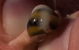 Kinh sợ ốc sên biển sống trong đầu gối bé trai