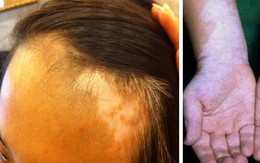 Bệnh bạch biến và bí quyết điều trị
