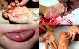 Đồng Nai: Trên 80% ca mắc tay chân miệng là trẻ dưới 3 tuổi