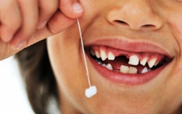 Có nên nhổ răng sữa ở trẻ em?