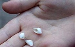 Vợ đánh chồng gãy răng vì không chịu chia tài sản