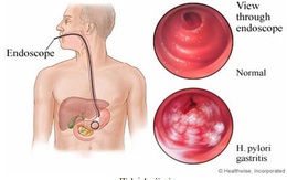 Viêm loét dạ dày tá tràng – Với phương thuốc hiệu nghiệm