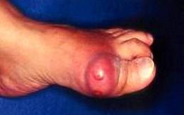 Khớp ngón chân cái sưng đỏ, đề phòng bệnh gút
