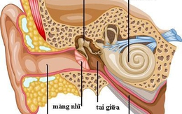 Nguy cơ suy giảm thính lực do viêm tai giữa