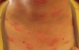 Chữa dị ứng mề đay hiệu quả bằng đông y