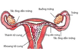 Các phương pháp chẩn đoán tắc nghẽn vòi trứng hay không