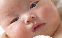 Cách trị trẻ nổi rôm sảy mùa hè đơn giản, hiệu quả