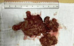 Phát hiện u sợi thần kinh khổng lồ