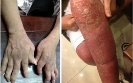 Phương thuốc bí truyền đặc trị vẩy nến ở Đông y Bảo Thanh Đường