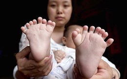 Lạ kỳ bé trai có 16 ngón chân ở Trung Quốc