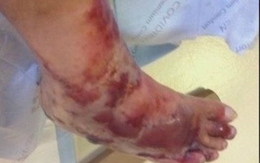 Người đàn ông bị vi khuẩn ăn thịt chân sau chuyến đi biển