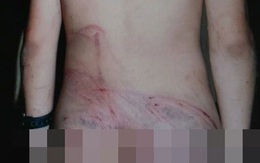 Thanh Hóa: Bé trai 10 tuổi bị bố đánh đến bầm tím toàn thân vì... để dê ăn sắn nhà hàng xóm