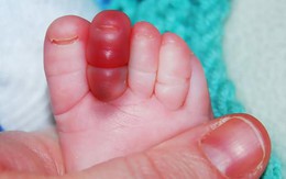 Trẻ có thể mất ngón chân tay chỉ từ... một sợi tóc rụng
