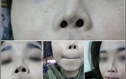 Cô gái Hà Nội bế tắc vì đã 2 lần đau đớn thẩm mỹ nhưng mũi vẫn... lệch