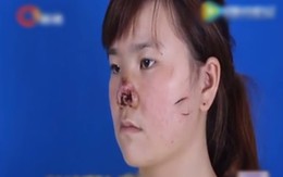 Thiếu nữ cưới chui, bị chồng cắn nát mũi