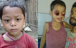 Ấn Độ: Cậu bé đáng thương mắc bệnh lạ, mắt lồi như sắp rớt ra ngoài