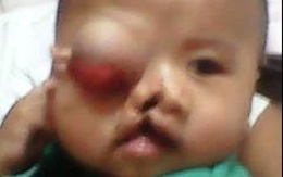 Rơi nước mắt trước khuôn mặt đa dị tật của bé trai 6 tháng tuổi