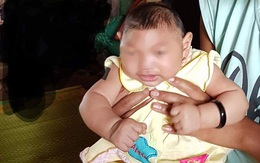 Bé gái 4 tháng tuổi ở Đắk Lắk nghi mắc chứng đầu nhỏ trong hoàn cảnh nào?