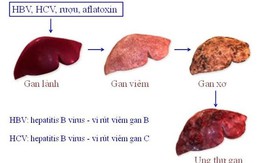 Những bệnh ung thư đến từ miệng