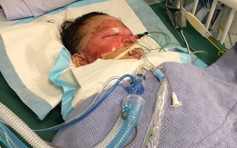 Bé trai 2 tuổi bỏng nặng vì với tay trúng chảo dầu đang sôi