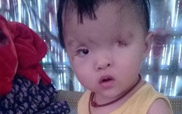 Bé gái 1 tuổi nguy cơ mù vĩnh viễn vì không có tiền phẫu thuật