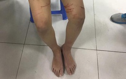 Hà Nội: Người cha lên tiếng về việc con gái 14 tuổi bị rạch đùi bằng dao lam trên phố