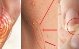 Dấu hiệu cơ thể thiếu hụt chất dinh dưỡng