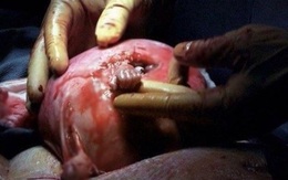 Thai nhi 21 tuần tuổi nắm chặt ngón tay bác sĩ gây chấn động thế giới giờ ra sao?