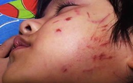 Giáo viên bỏ lớp, bé gái 4 tuổi bị bạn đánh “hội đồng”?