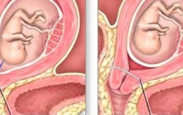 Hở eo cổ tử cung - bệnh dễ gây sảy thai ít người biết
