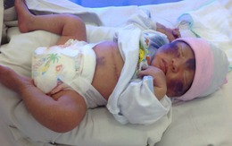 Em bé chào đời 36 giờ bị vỡ dạ dày hiếm gặp