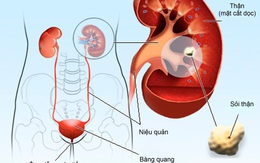 Suy thận – Biến chứng nguy hiểm từ sỏi thận