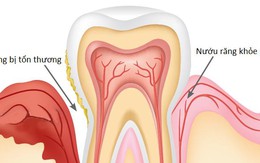 Bệnh nha chu – biến chứng răng miệng ở người đái tháo đường