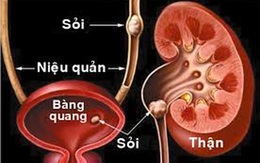 Vì sao uống nhiều nước giúp ngừa sỏi thận?