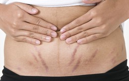 Nghiên cứu: Rạn da có tính chất di truyền hay không?