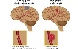 Nhiều người Việt có nguy cơ bị đột quỵ vì chủ quan với bệnh mỡ máu