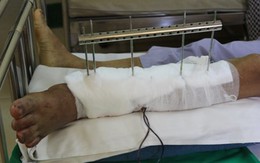 Phẫu thuật thành công bệnh nhân bị đứt rời cẳng chân trái