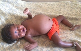 Bào thai ký sinh nặng 3,5 kg trong bụng bé một tuổi